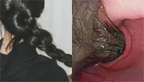 Rare surgery: 1-kg hairball removed from 9-year-old girl’s stomach, intestine in Kerala
